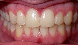 anterior crossbite after