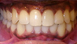 anterior crossbite after
