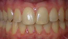 anterior crossbite after