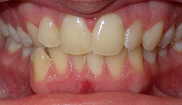 anterior crossbite before