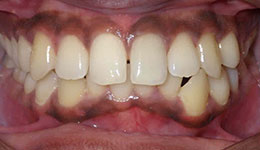 anterior crossbite before