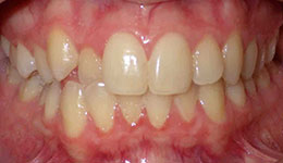 anterior crossbite before