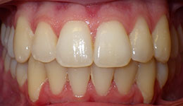 crowding of the teeth after