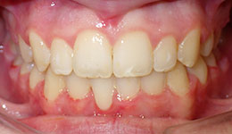 crowding of the teeth after