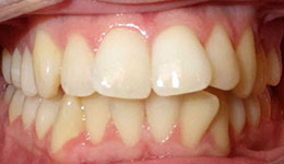 crowding of the teeth before