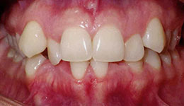 crowding of the teeth before