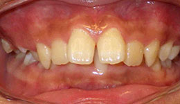 deep overbite before