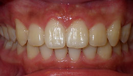 deep overbite after