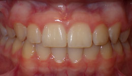 high canines after