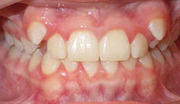 high canines before