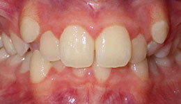 deep overbite before