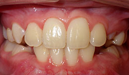 phase 1 after