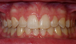 spacing of teeth after