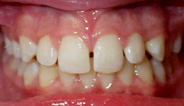 spacing of teeth before