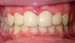 deep overbite after