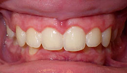 deep overbite before