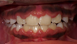 underbite after